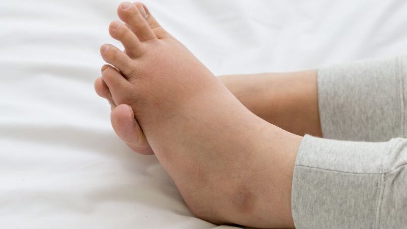 Opuchnięte łydki – co może oznaczać puchnięcie nóg?